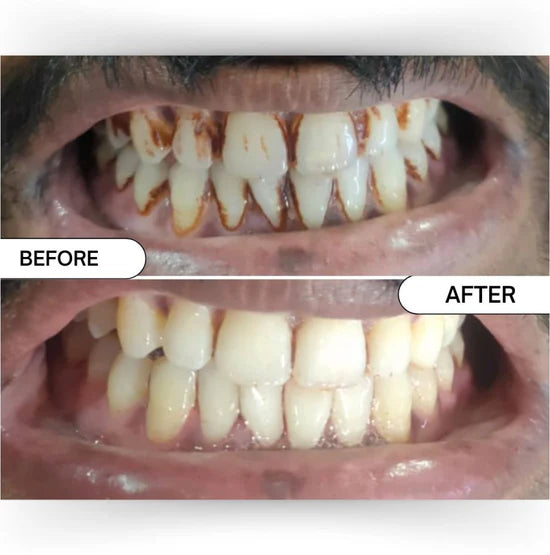 Teeth Whitening Powder